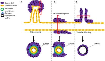 Novel Pathways for Targeting Tumor Angiogenesis in Metastatic Breast Cancer